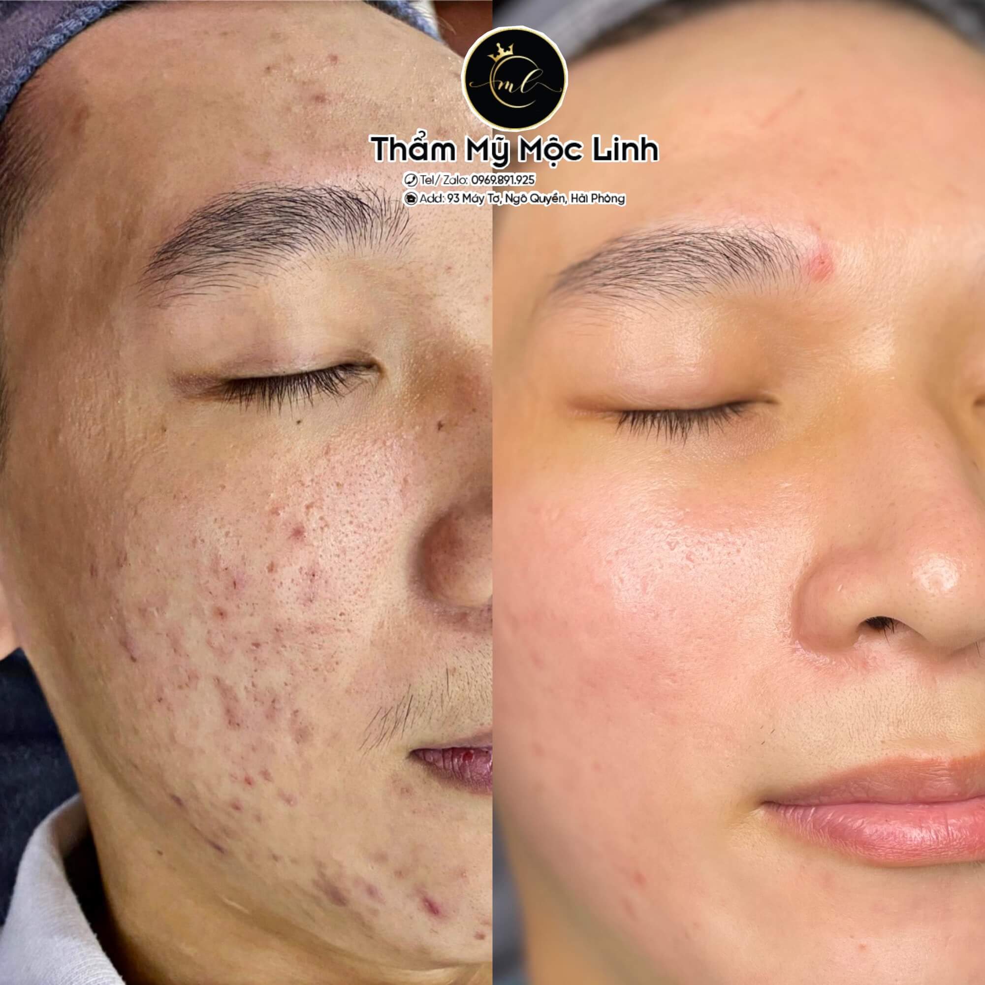 Điều trị sẹo lâu năm tại thẩm mỹ viện Mộc Linh Hải tại Thẩm Mỹ Mộc Linh Hải Phòng - hình 2
