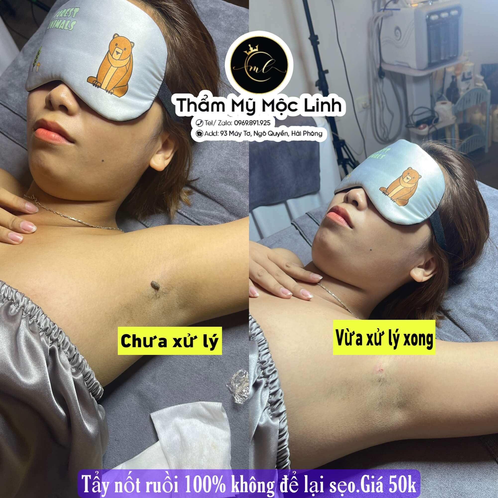 Xoá Nốt Ruồi Hiệu Quả Với Công Nghệ Laser tại Thẩm Mỹ Mộc Linh Hải Phòng - hình 1