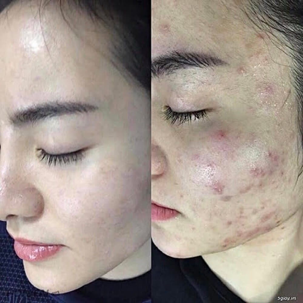 Cơ sở đào tạo điều trị mụn chuẩn y khoa uy tín tại Hải tại Thẩm Mỹ Mộc Linh Hải Phòng