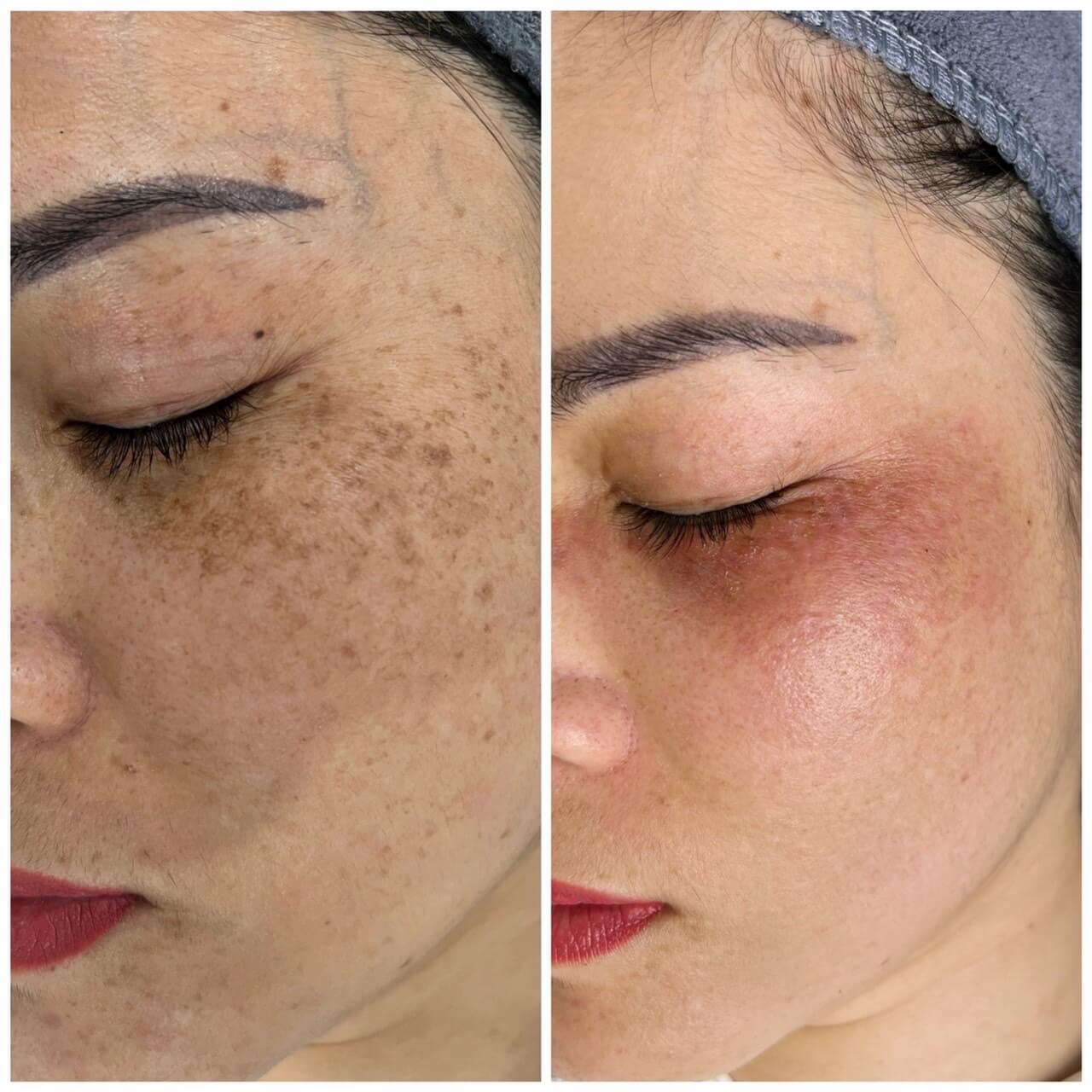 Điều trị tàn nhang tại Thẩm Mỹ Mộc Linh Hải Phòng