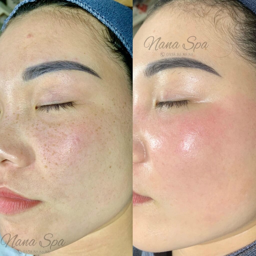 Trị nám/tàn nhang uy tín tại Hải Phòng tại Thẩm Mỹ Mộc Linh - hình 88