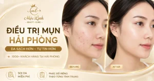 Trị Mụn Số 1 Hải Phòng tại Thẩm Mỹ Mộc Linh - hình 31