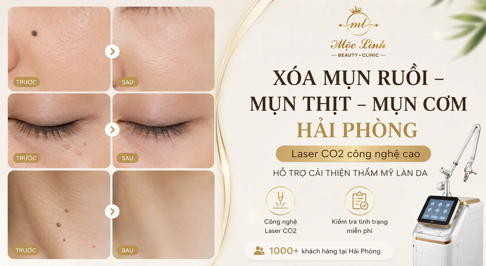 Tẩy nốt ruồi, mụn cơm, mụn thịt tại Thẩm Mỹ Mộc Linh Hải Phòng - hình 1