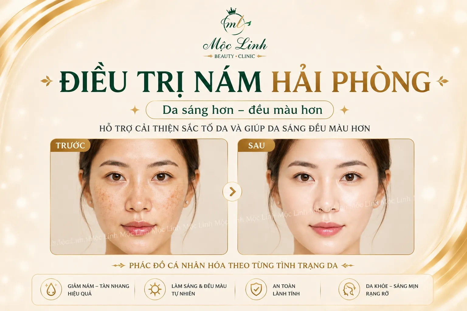 Điều trị nám tại Thẩm Mỹ Mộc Linh Hải Phòng