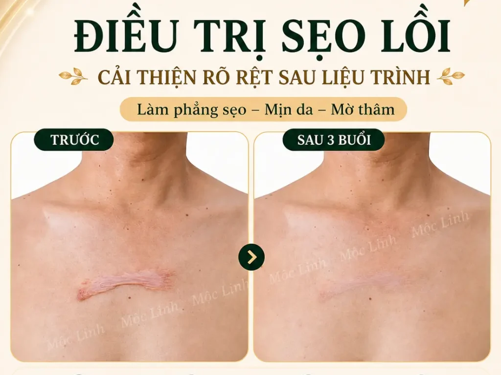 Điều trị các loại sẹo uy tín Hải Phòng tại Thẩm Mỹ Mộc Linh - hình 21