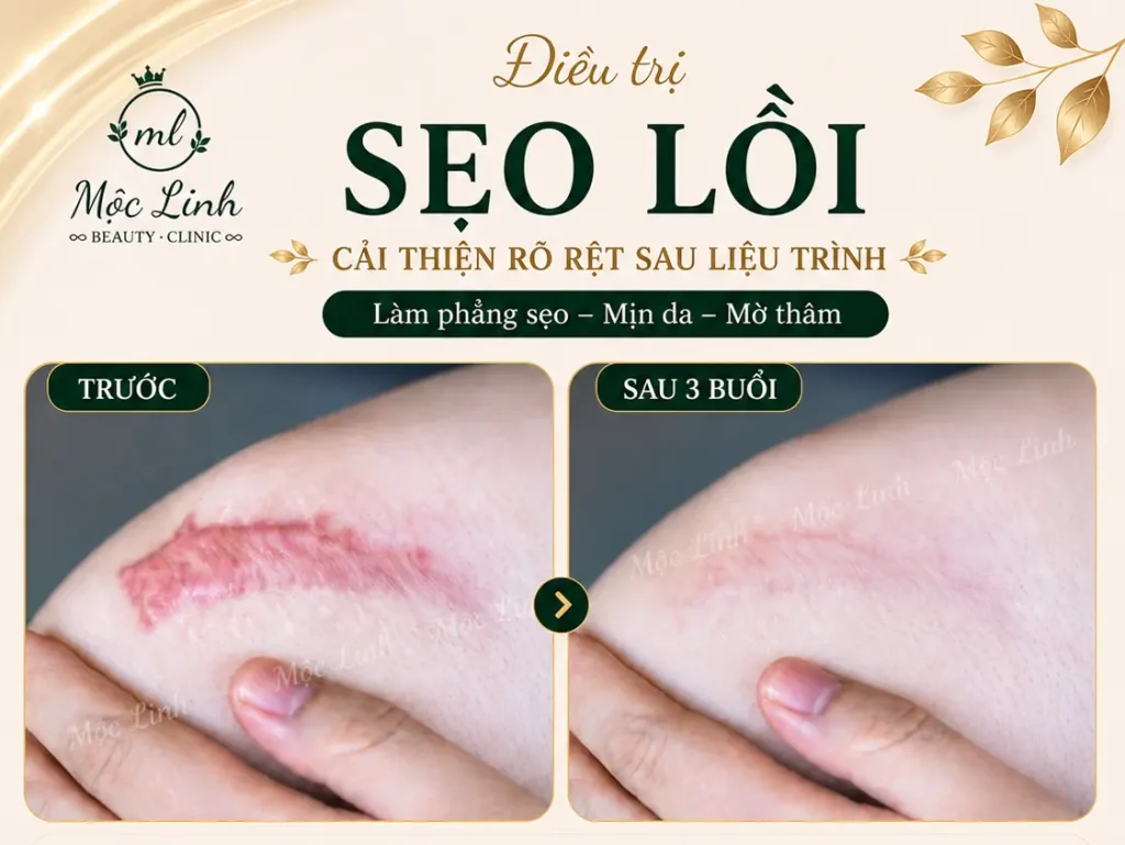 Điều trị các loại sẹo uy tín Hải Phòng tại Thẩm Mỹ Mộc Linh - hình 20