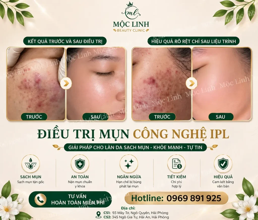 Khách hàng hài lòng với kết quả trị mụn tại Mộc Linh Hải Phòng