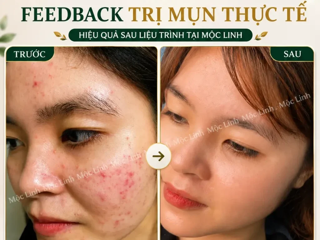 Phản hồi khách hàng sau điều trị mụn tại Mộc Linh Hải Phòng