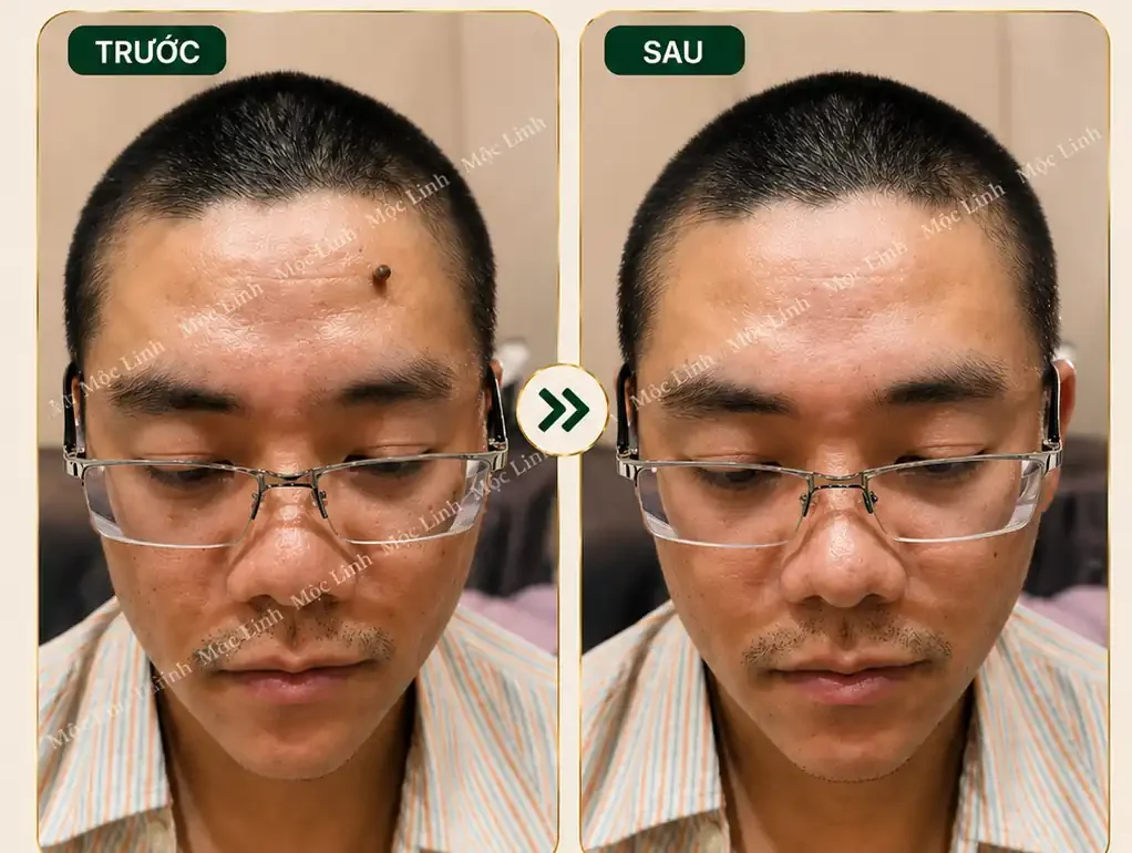 Tẩy nốt ruồi, mụn cơm, mụn thịt tại Thẩm Mỹ Mộc Linh Hải Phòng - hình 6