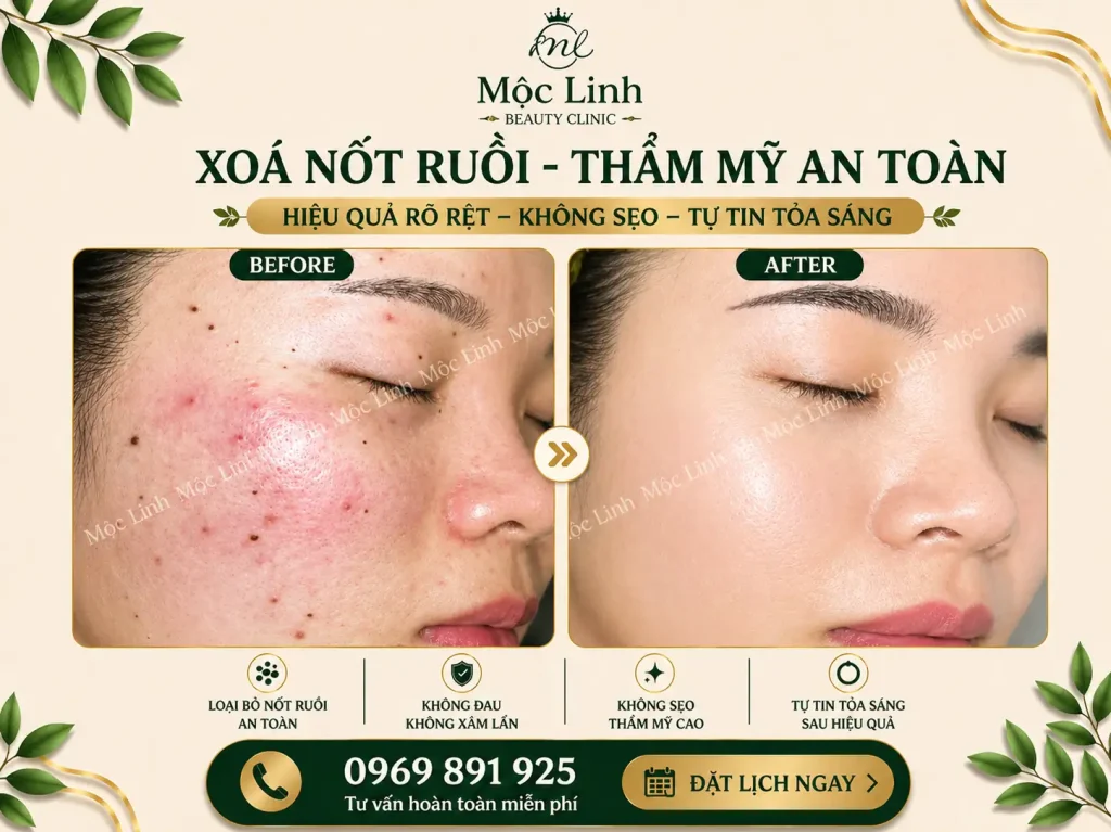Tẩy nốt ruồi, mụn cơm, mụn thịt tại Thẩm Mỹ Mộc Linh Hải Phòng - hình 24