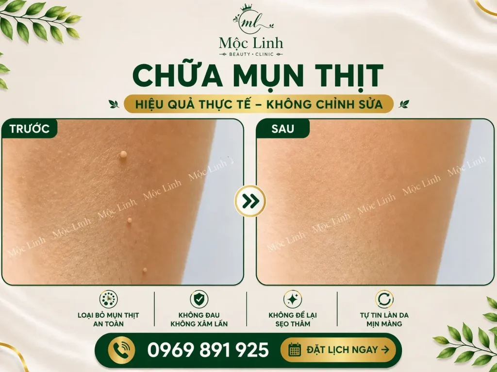 Tẩy nốt ruồi, mụn cơm, mụn thịt tại Thẩm Mỹ Mộc Linh Hải Phòng - hình 2