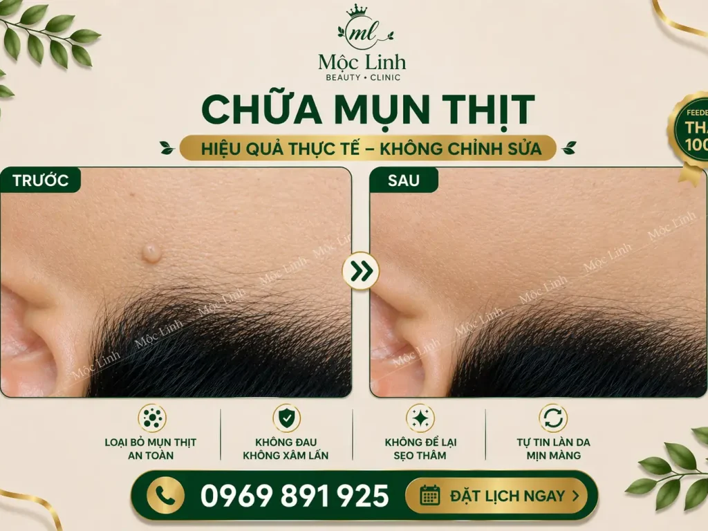 Tẩy nốt ruồi, mụn cơm, mụn thịt tại Thẩm Mỹ Mộc Linh Hải Phòng - hình 16