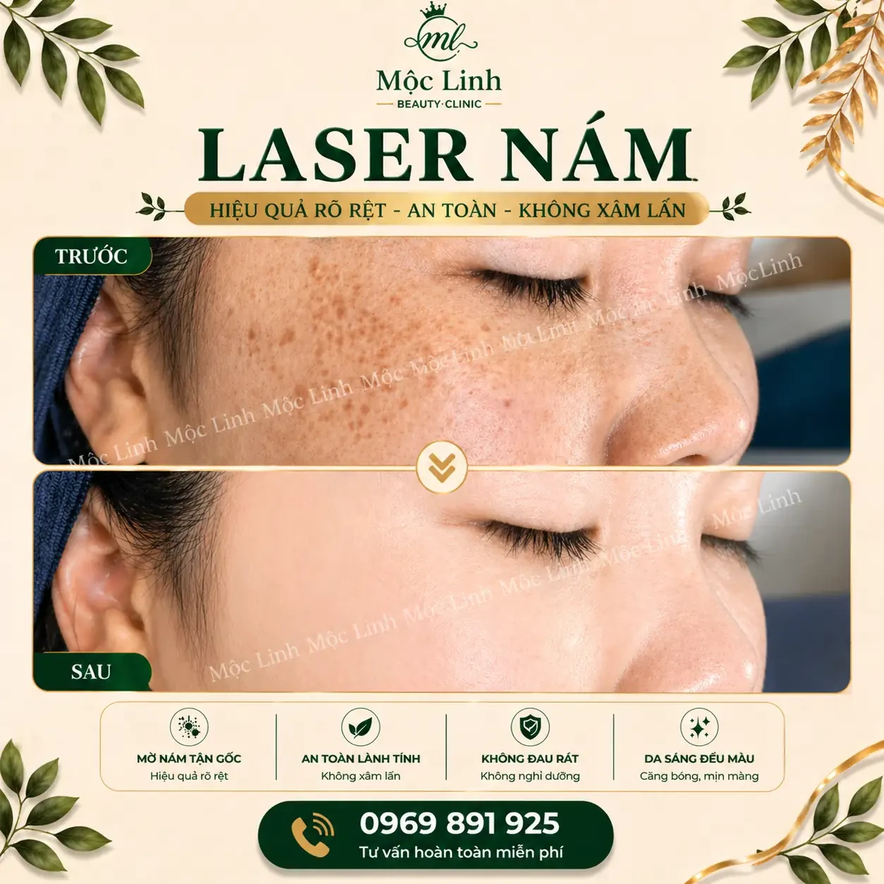 Điều trị nám da tại Thẩm Mỹ Mộc Linh Hải Phòng