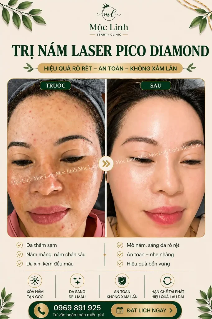 Trị nám/tàn nhang uy tín tại Hải Phòng tại Thẩm Mỹ Mộc Linh - hình 15