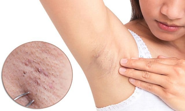Triệt lông nách tại Thẩm Mỹ Mộc Linh Hải Phòng - hình 2