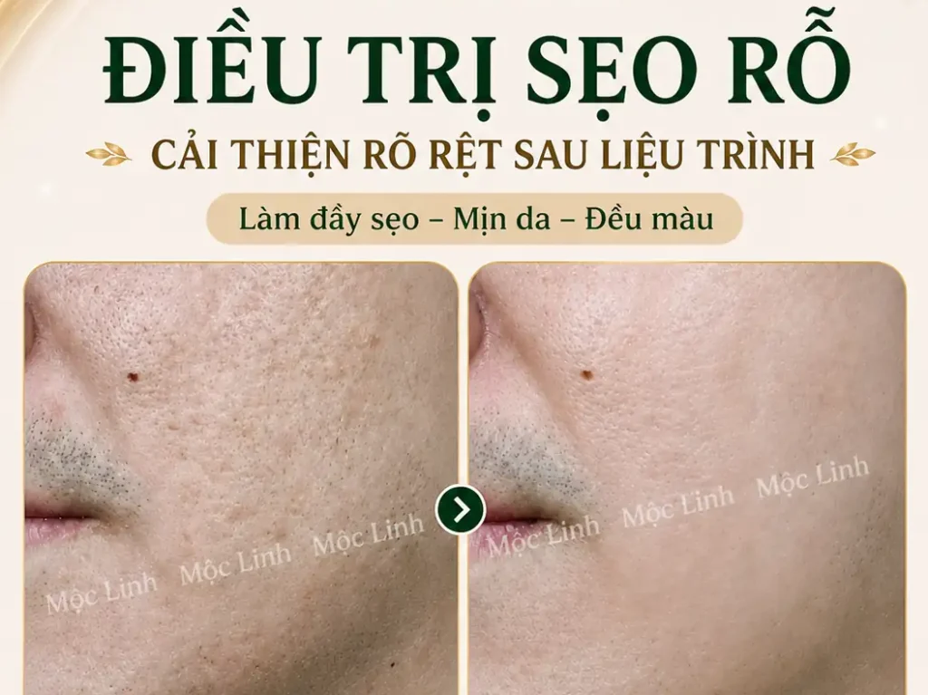 Điều trị các loại sẹo uy tín Hải Phòng tại Thẩm Mỹ Mộc Linh - hình 16