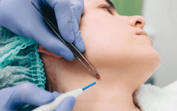 Chăm sóc sau khi tẩy nốt ruồi để hạn chế sẹo và thâm tại Hải Phòng