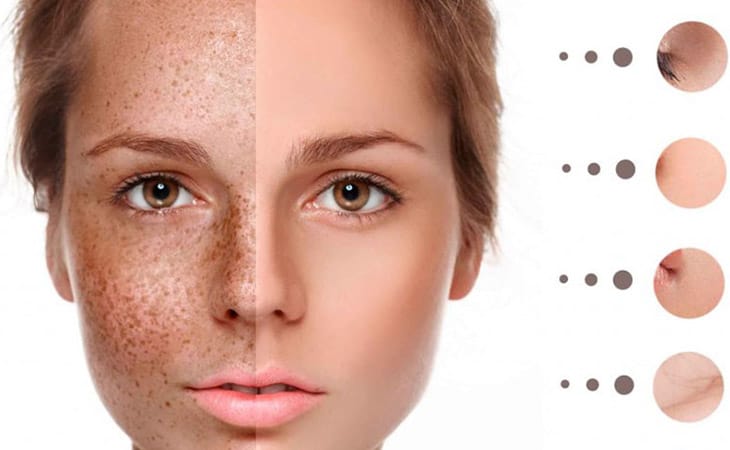 Điều trị tàn nhang tại Thẩm Mỹ Mộc Linh Hải Phòng - hình 4