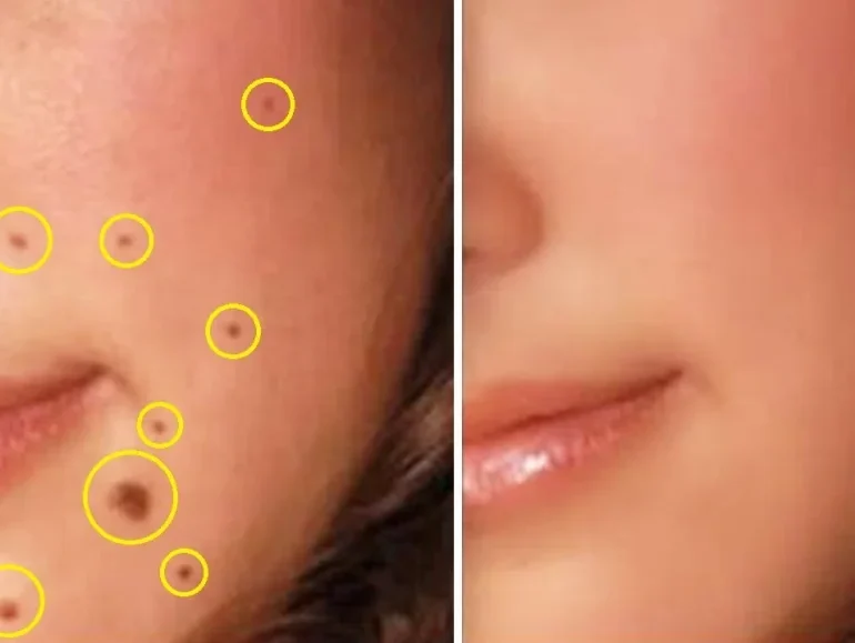 Tẩy nốt ruồi có để lại sẹo không – giải đáp tại Thẩm Mỹ Mộc Linh Hải Phòng