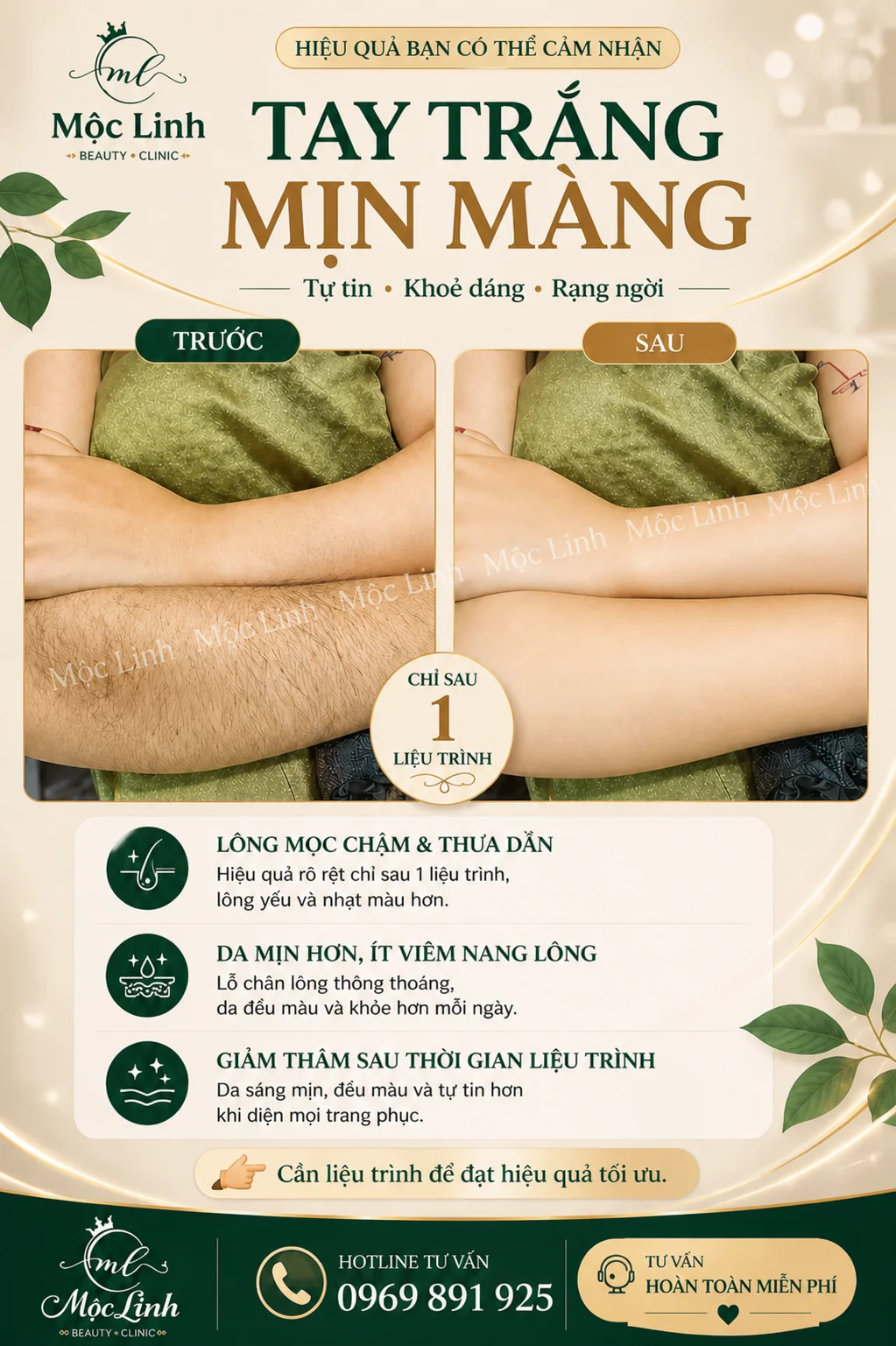 Triệt lông chân an toàn công nghệ cao tại Hải Phòng