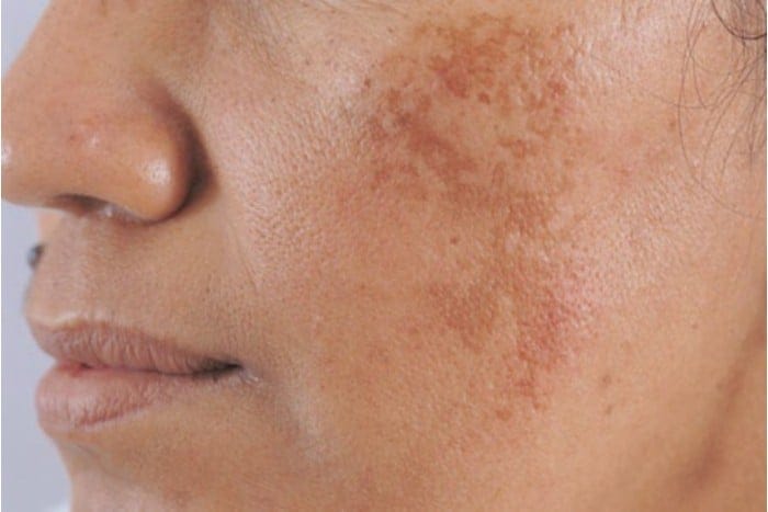 Điều trị tăng sắc tố da tại Thẩm Mỹ Mộc Linh Hải Phòng - hình 1
