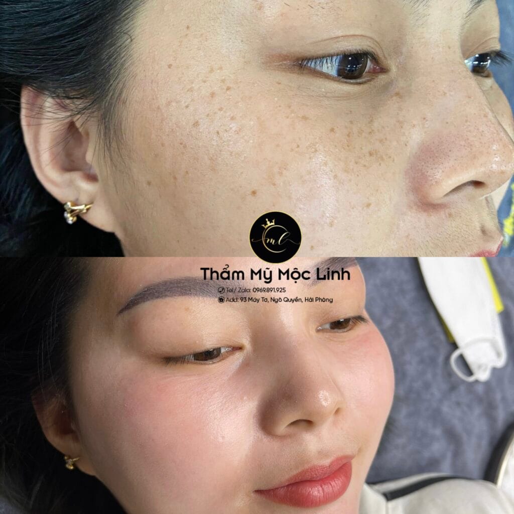 Trị nám/tàn nhang uy tín tại Hải Phòng tại Thẩm Mỹ Mộc Linh - hình 85
