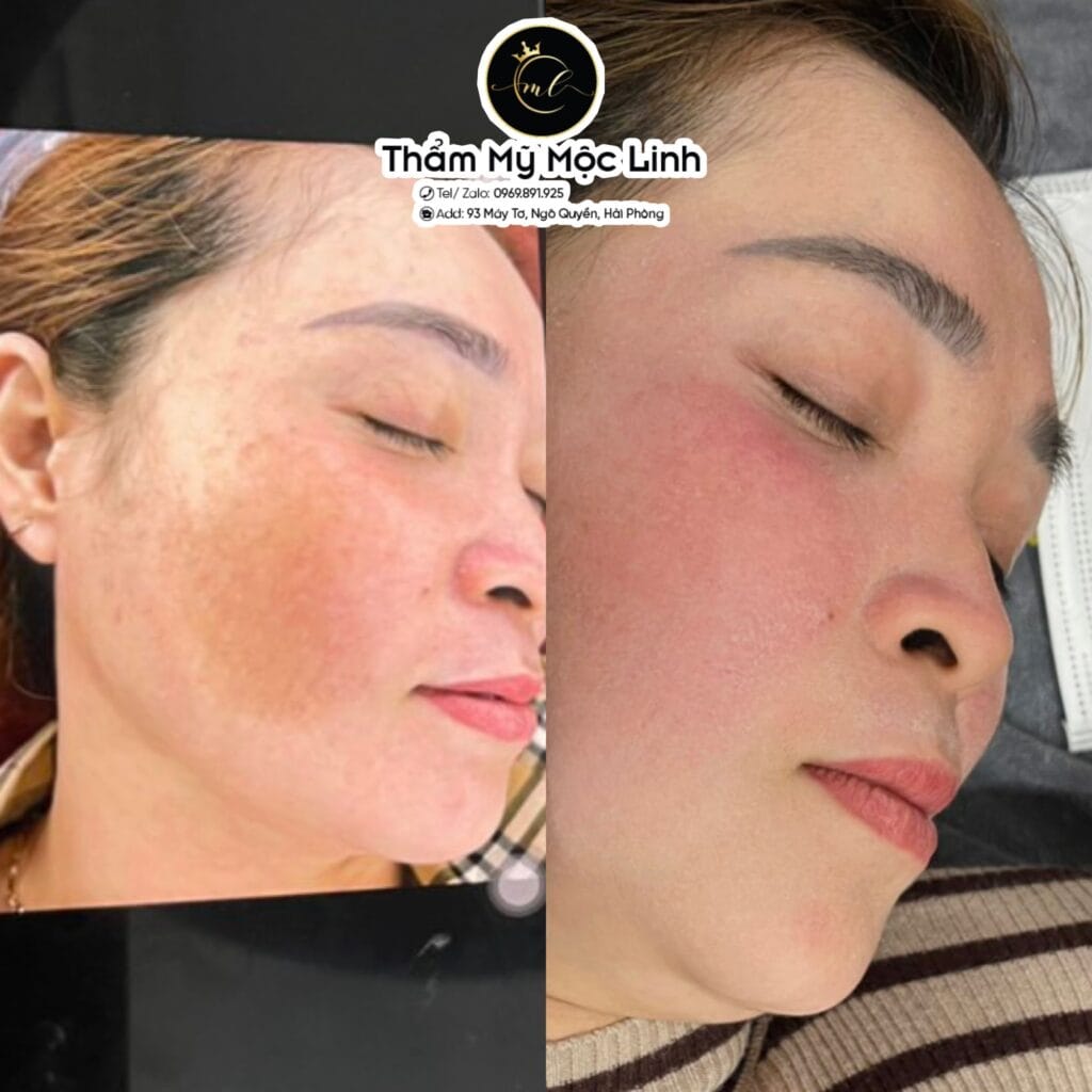Trị nám/tàn nhang uy tín tại Hải Phòng tại Thẩm Mỹ Mộc Linh - hình 81