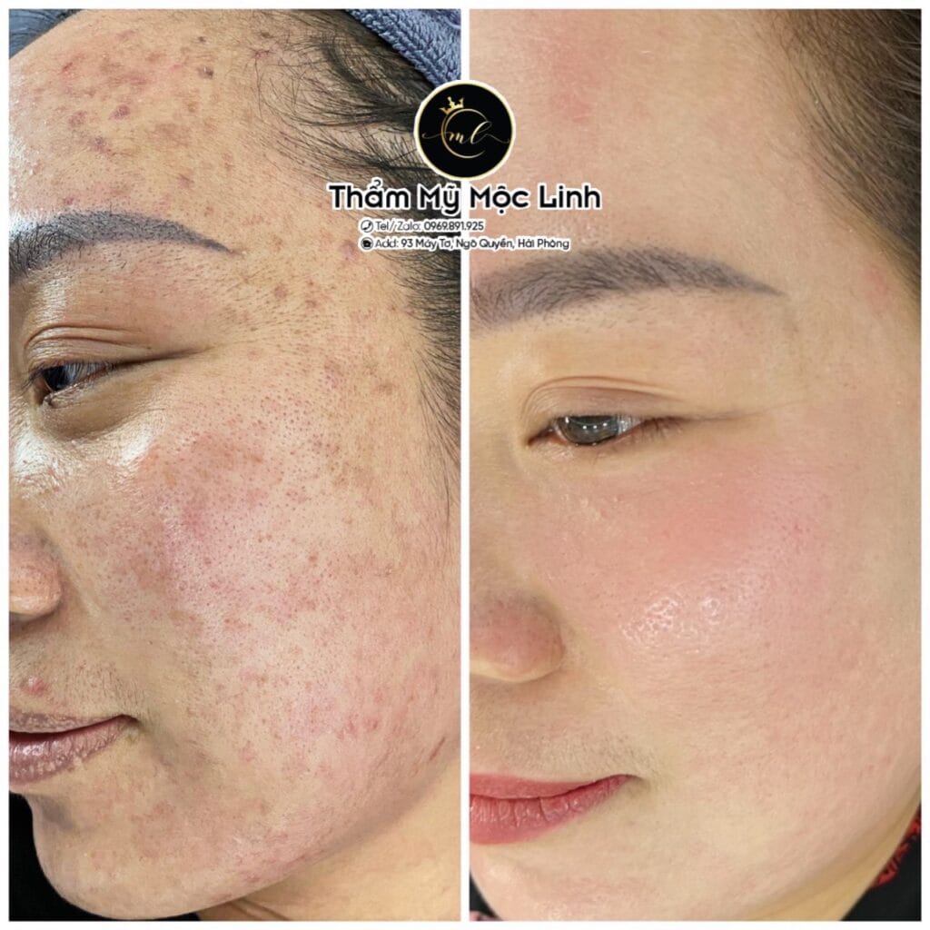 Trị nám/tàn nhang uy tín tại Hải Phòng tại Thẩm Mỹ Mộc Linh - hình 79
