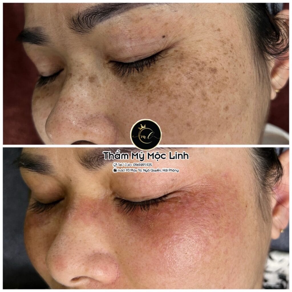 Trị nám/tàn nhang uy tín tại Hải Phòng tại Thẩm Mỹ Mộc Linh - hình 78