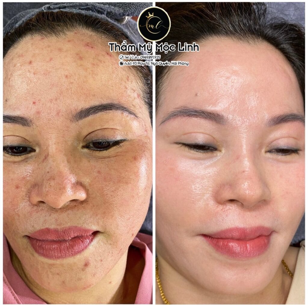 Trị nám/tàn nhang uy tín tại Hải Phòng tại Thẩm Mỹ Mộc Linh - hình 76