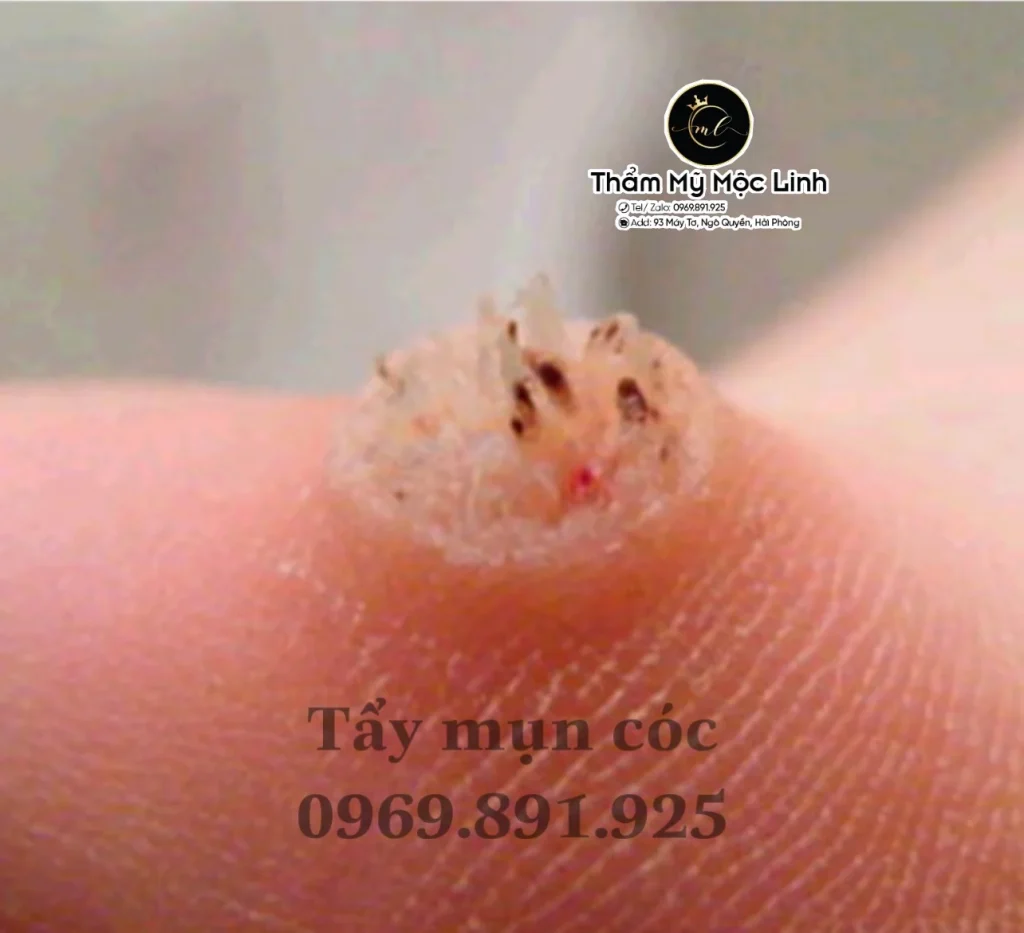 Tẩy nốt ruồi, mụn cơm, mụn thịt tại Thẩm Mỹ Mộc Linh Hải Phòng - hình 8
