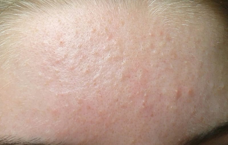 Phân biệt các kiểu mụn thường gặp tại Thẩm Mỹ Mộc Linh Hải Phòng - hình 2
