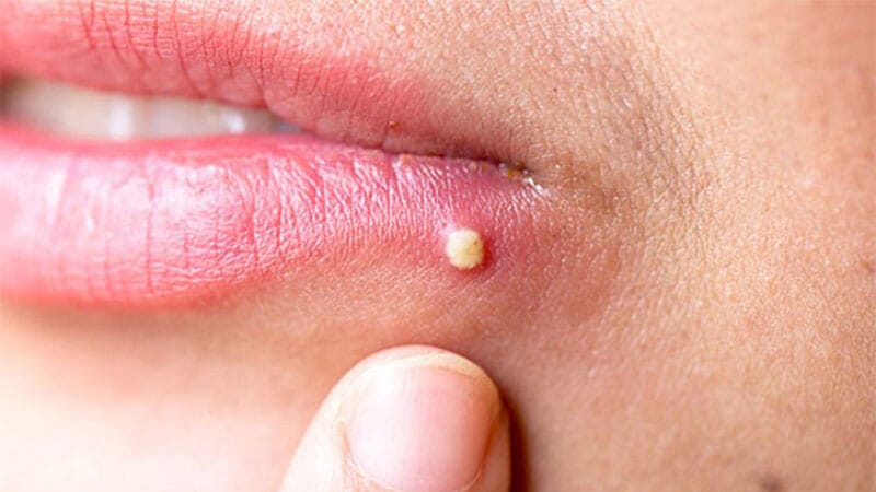 Phân biệt các kiểu mụn thường gặp tại Thẩm Mỹ Mộc Linh Hải Phòng - hình 5