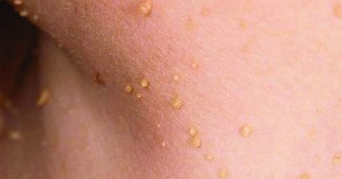 Phân biệt các kiểu mụn thường gặp tại Thẩm Mỹ Mộc Linh Hải Phòng - hình 6