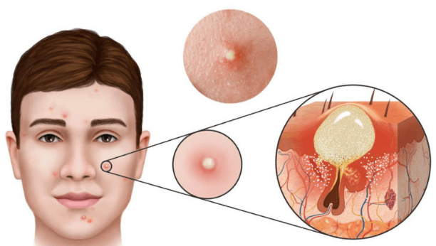Phân biệt các kiểu mụn thường gặp tại Thẩm Mỹ Mộc Linh Hải Phòng - hình 1