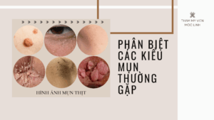 Phân biệt các kiểu mụn thường gặp tại Thẩm Mỹ Mộc Linh Hải Phòng - hình 1