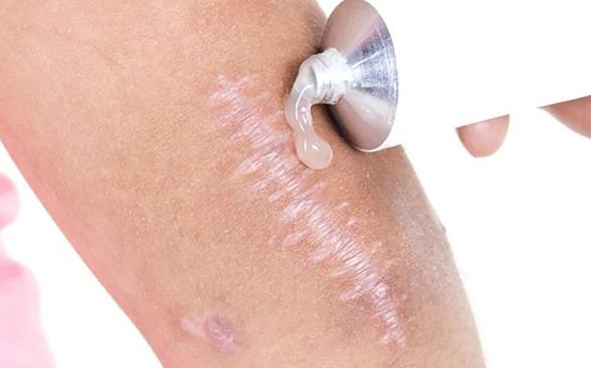 Điều trị sẹo lâu năm tại thẩm mỹ viện Mộc Linh Hải tại Thẩm Mỹ Mộc Linh Hải Phòng - hình 1