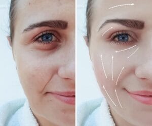 Tiêm Đầy rãnh cười tại Thẩm Mỹ Mộc Linh Hải Phòng - hình 1