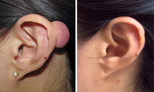 Xử lí sẹo lồi vành tai cam kết chất lượng dịch vụ cho tại Thẩm Mỹ Mộc Linh Hải Phòng - hình 1