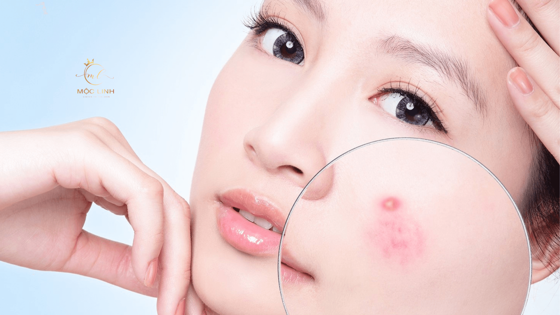 5 lý do khiến da bị mụn và cách chữa trị tại Thẩm Mỹ Mộc Linh Hải Phòng - hình 2