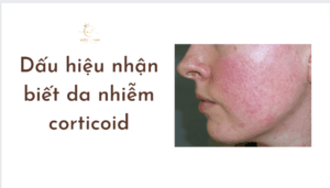 Dấu hiệu nhận biết da nhiễm corticoid tại Thẩm Mỹ Mộc Linh Hải Phòng - hình 3
