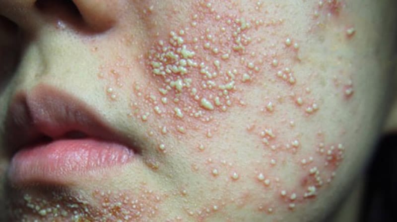 Dấu hiệu nhận biết da nhiễm corticoid tại Thẩm Mỹ Mộc Linh Hải Phòng - hình 1