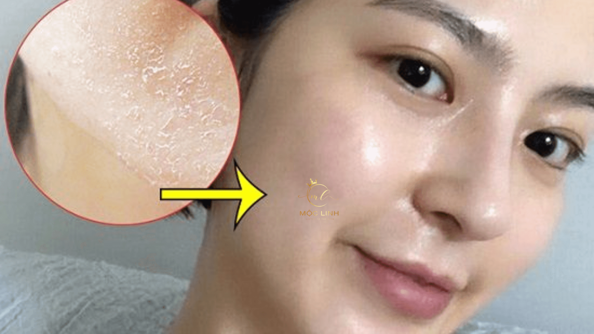 Peel da có phải phương pháp tốt ? tại Thẩm Mỹ Mộc Linh Hải Phòng - hình 1