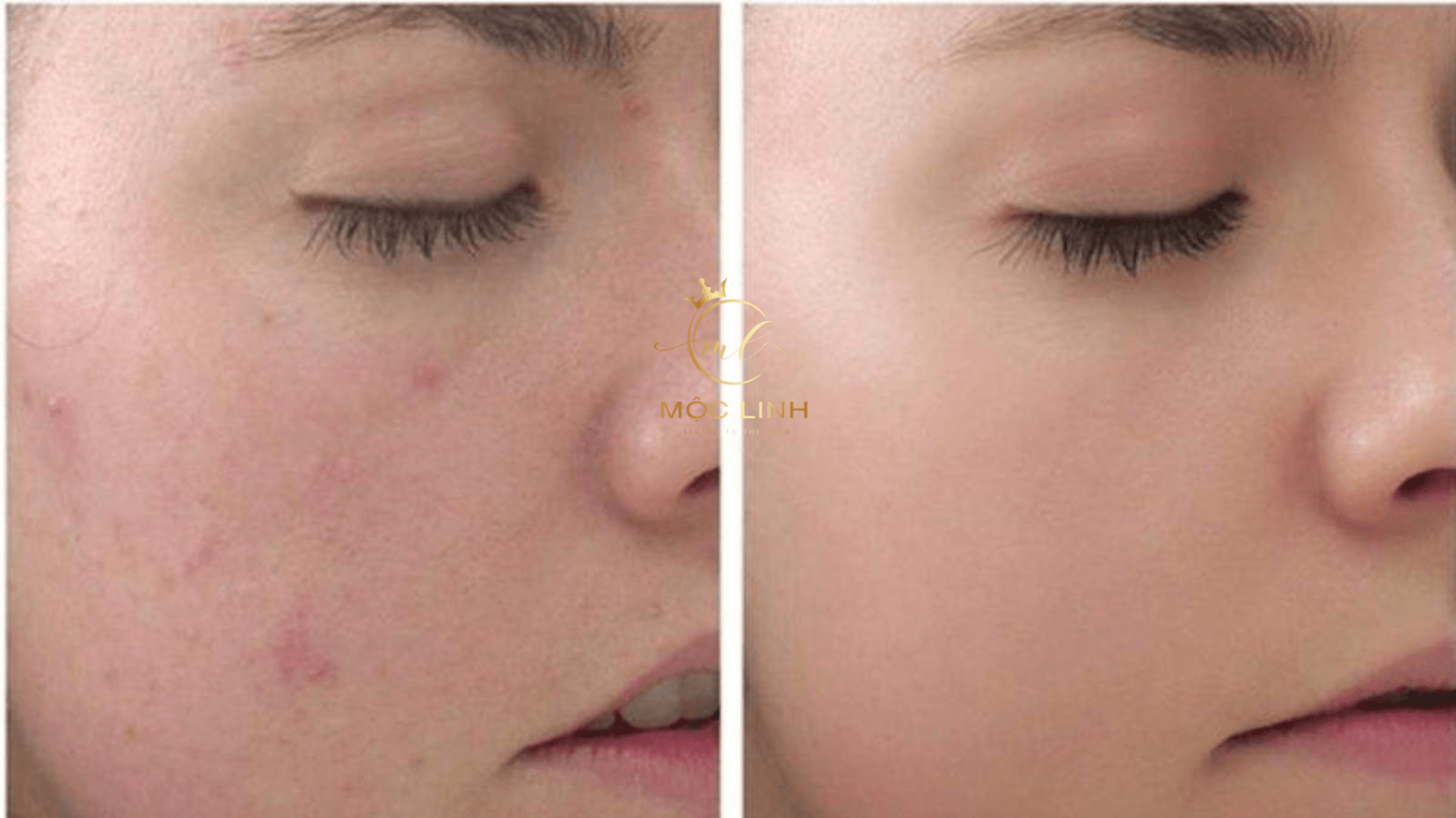 Peel da có phải phương pháp tốt ? tại Thẩm Mỹ Mộc Linh Hải Phòng - hình 2