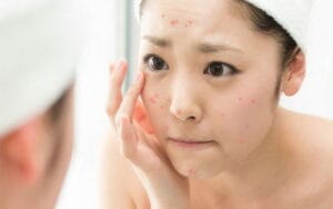 5 lý do khiến da bị mụn và cách chữa trị tại Thẩm Mỹ Mộc Linh Hải Phòng - hình 1