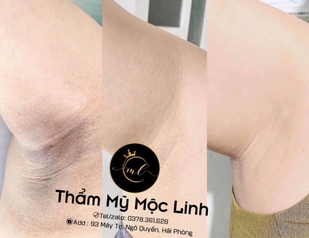 Cách Trị Thâm Nách Đơn Giản, Hiệu Quả Và Nhanh Chóng tại Thẩm Mỹ Mộc Linh Hải Phòng - hình 2