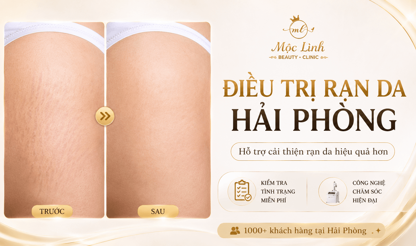 Chữa rạn da tại Thẩm Mỹ Mộc Linh Hải Phòng