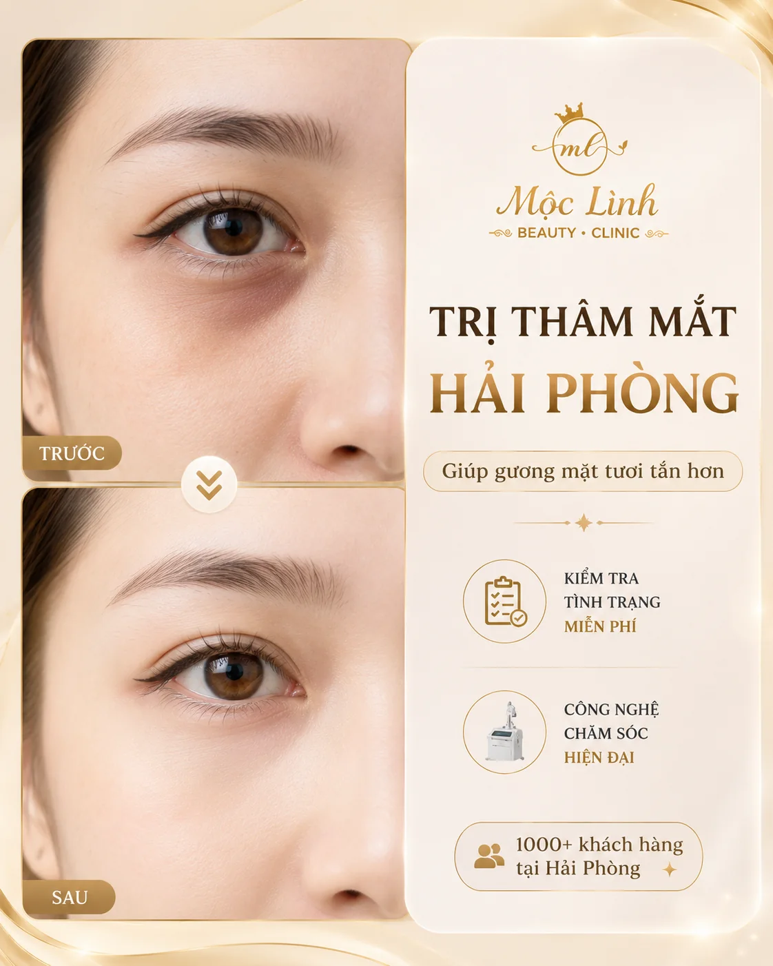Chữa thâm mắt uy tín Hải Phòng tại Thẩm Mỹ Mộc Linh - hình 1