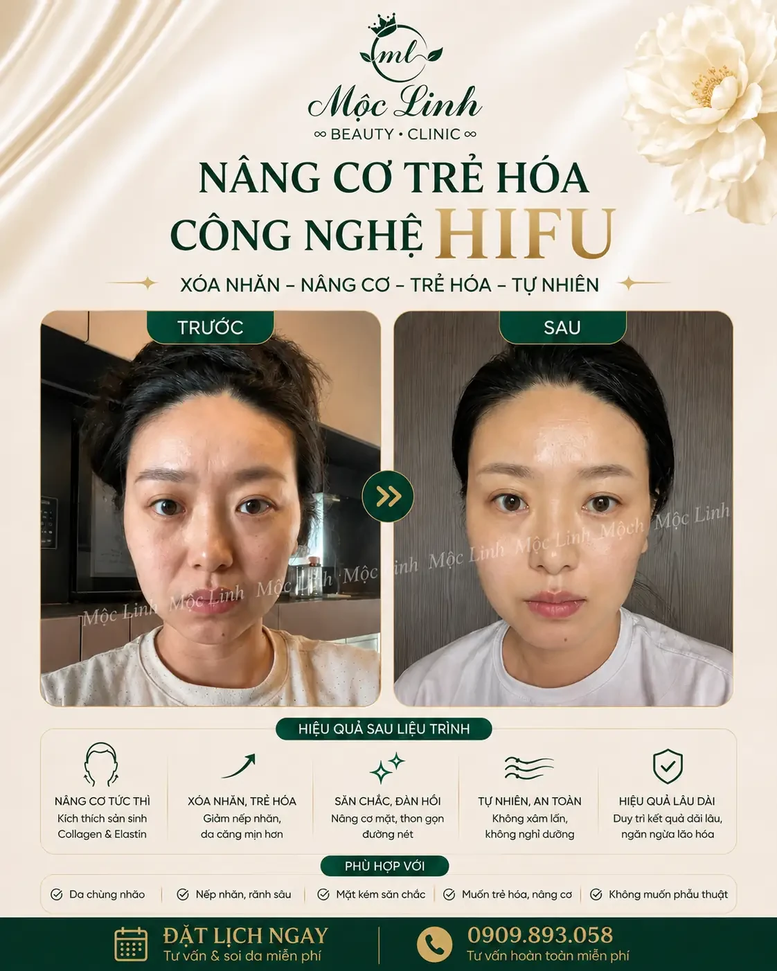 Nâng cơ công nghệ Hifu hiện đại bậc nhất tại Thẩm Mỹ Mộc Linh Hải Phòng - hình 3