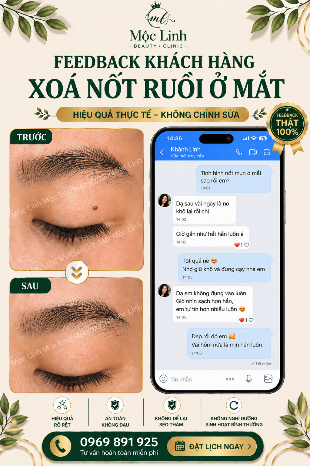 Xoá nốt ruồi an toàn Hải Phòng tại Thẩm Mỹ Mộc Linh - hình 5